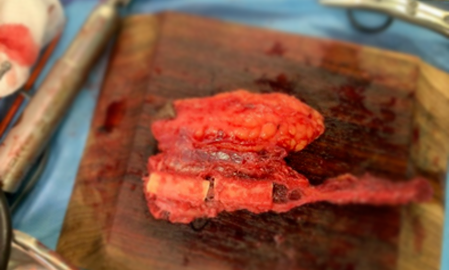 Jaw Bone Cancer